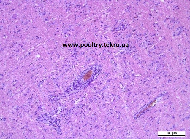 5 Mozok. Prolіferacіja glіalnih elementіv v rechovinі golovnogo mozku