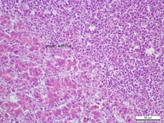 Dyfuzna infiltraciya v parenximi pechinky polimorfny my