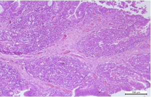 Fabricієva bursa Rozrostannja spoluchnotkaninnoї stromi mіzh lіmfoїdnimi folіkulami