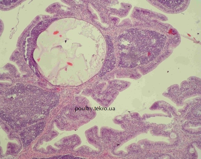 Fabricієva bursa Utvorennja kіst lіmfoїdnih vuzlikah