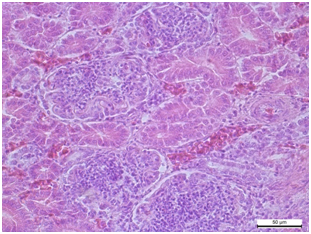 Nirka Mezengіalno prolіferativnij glomerulіt