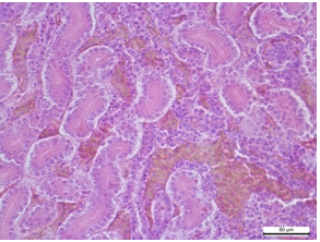 Nirka Іntersticіalnij nefrit