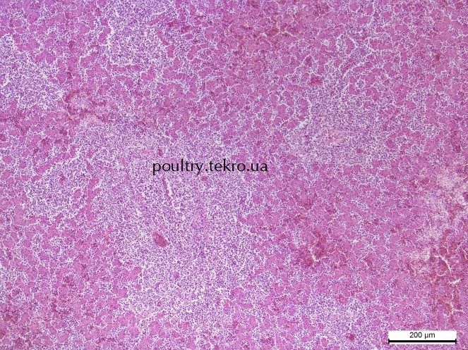 Pechinka. Dyfuzna infiltraciya parenximy limfoblastny my klitynamy