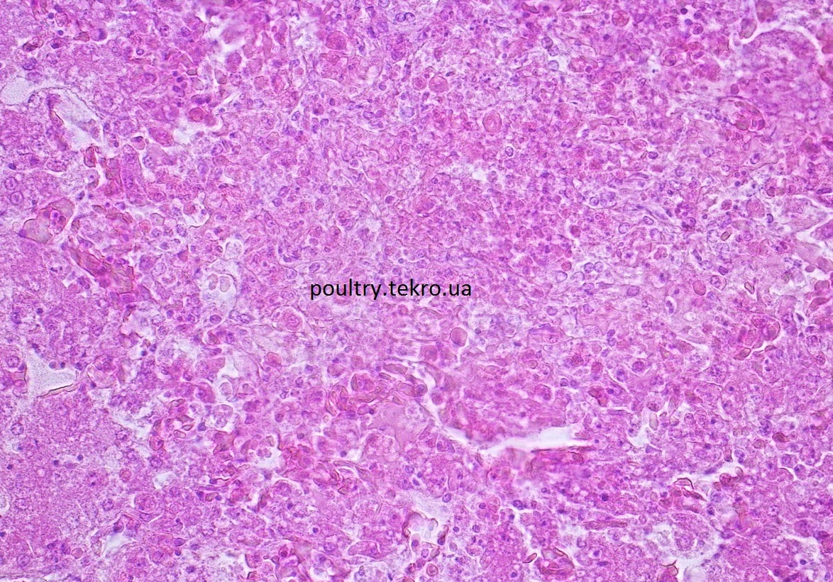 Pechіnka. Vakuolna distrofіja gepatocitіv z areaktivnimi nekrozami