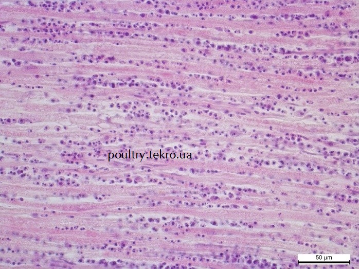 Proliferaciya plechovogo nervu limfoblastny my klitynamy