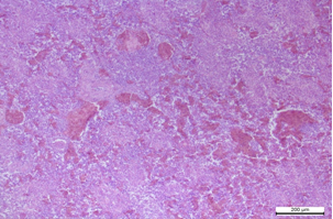 Selezіnka Gostra zastіjna gіperemіja atrofіja lіmfoїdnih folіkulіv