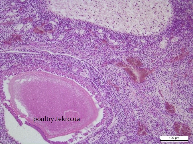 Yayechnyk. Infiltraciya spoluchnoyi tkanyny folikula polimorfnymy limfoblastnymy klitynamy